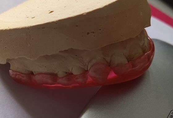Σκληρή ακρυλική άνω γναθιαία φρουρά σταθεροποίησης αψίδων για Bruxism