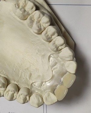 Άνετη κατάλληλη μαλακή αόρατη οδοντοστοιχία ISO13485 RPD
