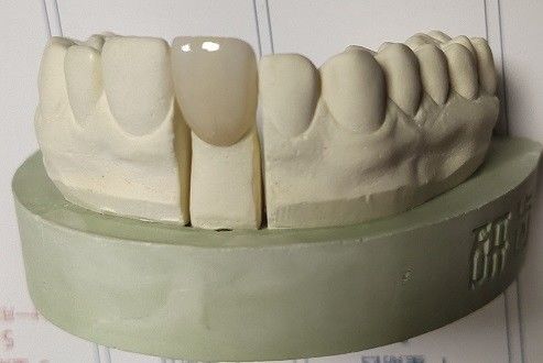 Το Zirconia εμποδίζει την οδοντική τρισδιάστατη τυπωμένη ύλη από την άλεση CAM CAD