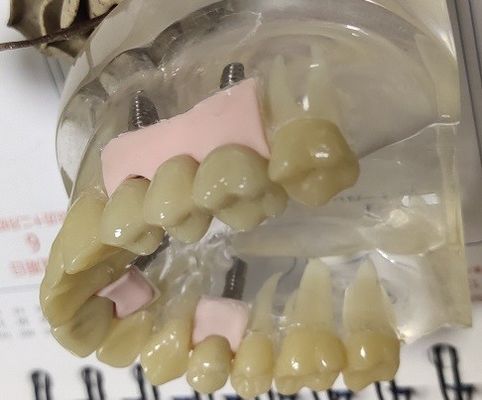 Προσωρινή κορώνα Biocompatibility PMMA 100 τοις εκατό