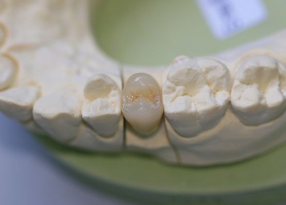 Κεραμικές EMAX Aesthethics μεταγενέστερες κορώνες γυαλιού για τους τραπεζίτες