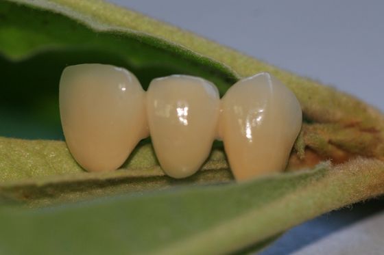ISO13485 καλή πολύτιμη οδοντική κορώνα Biocompatibility PFM μη