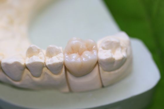 Κεραμικές EMAX Aesthethics μεταγενέστερες κορώνες γυαλιού για τους τραπεζίτες